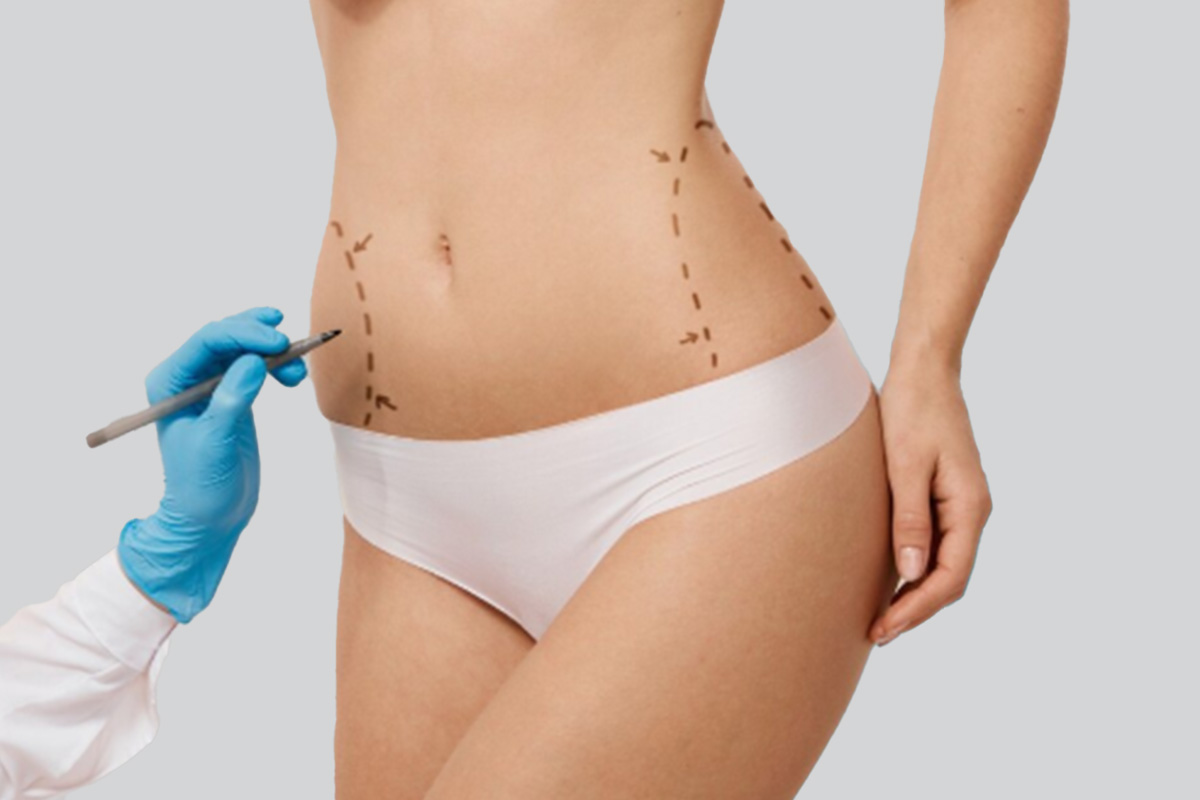 Abdominoplastie în Turcia