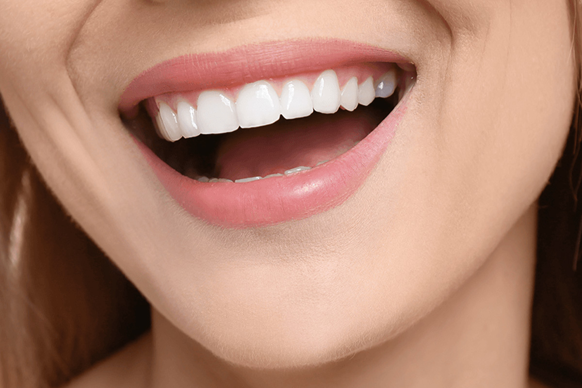 Hollywood Smile în Turcia