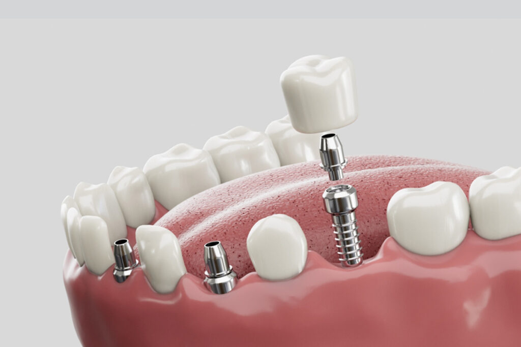 Implant Dentar în Turcia