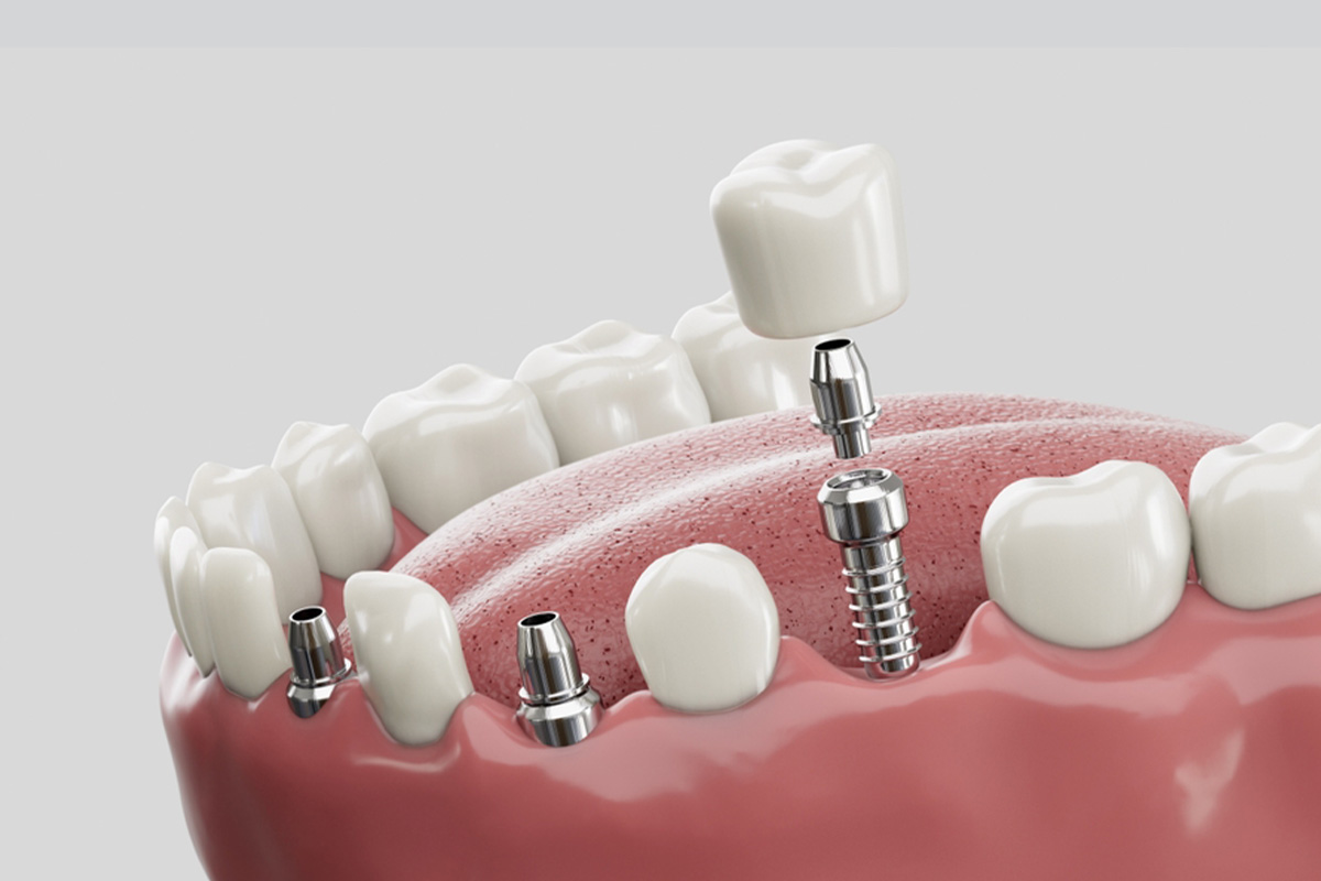 Implant Dentar în Turcia