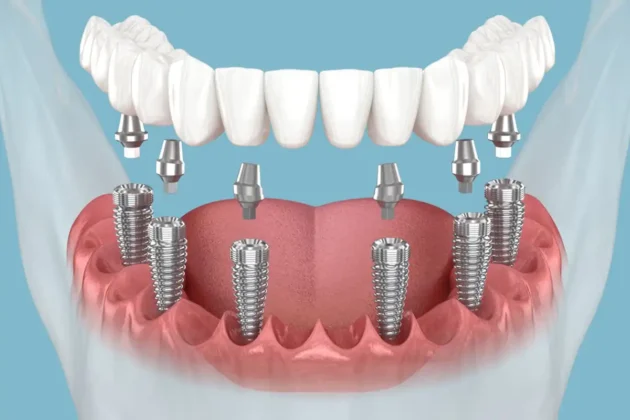 Diş implantı